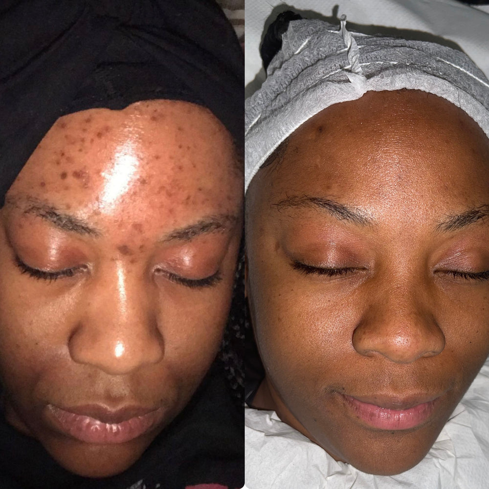 Skin Transformation Result