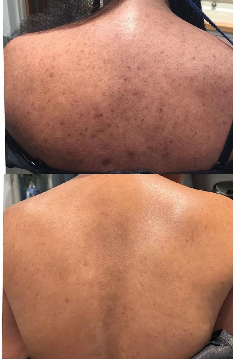 Treatment Result