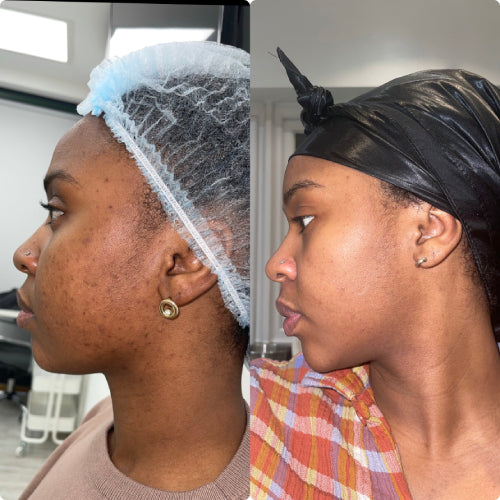 Skin Transformation Result