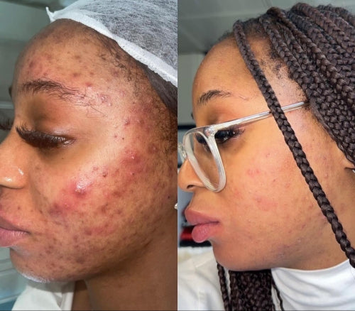 Skin Transformation Result