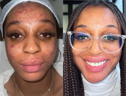 Skin Transformation Result