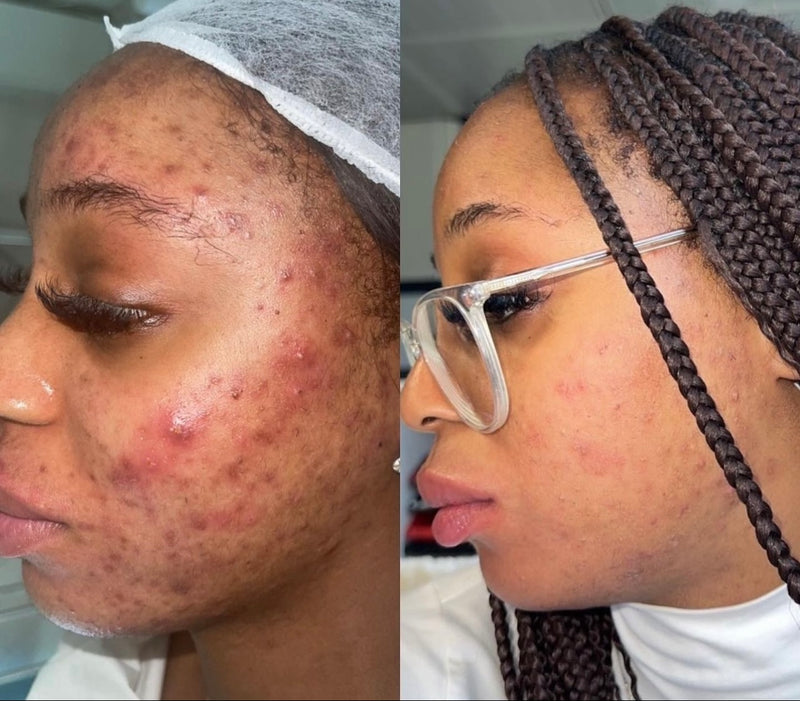 Treatment Result