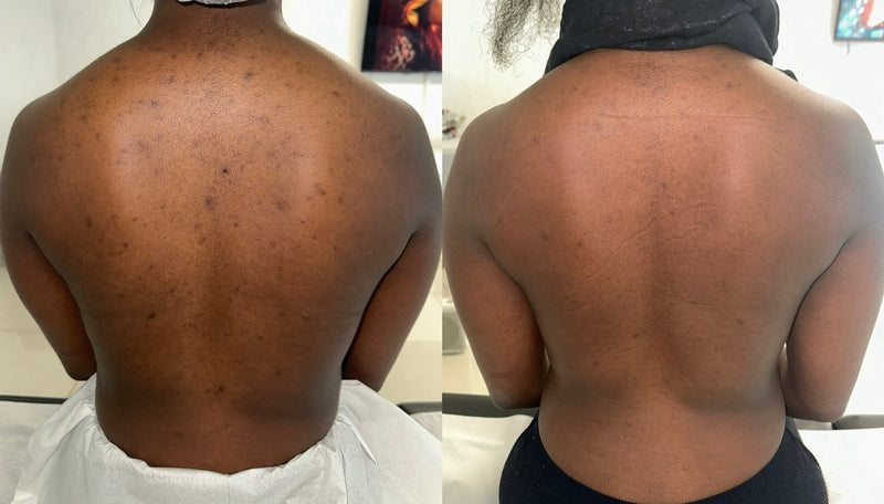 Treatment Result