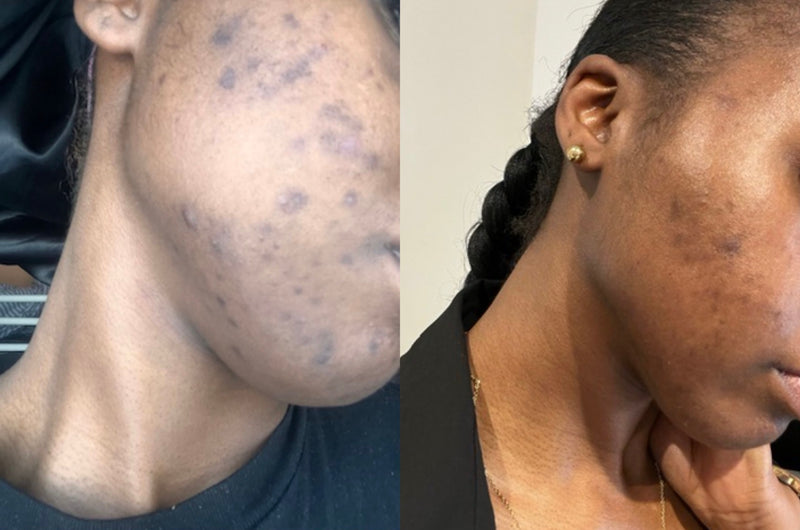 Treatment Result