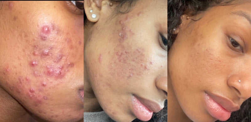 Treatment Result