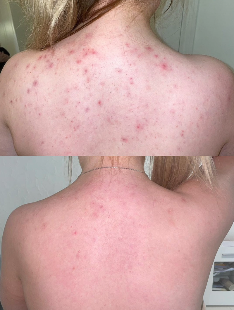 Treatment Result