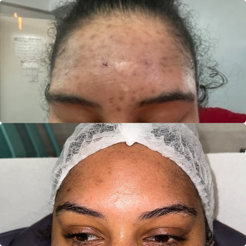 Treatment Result