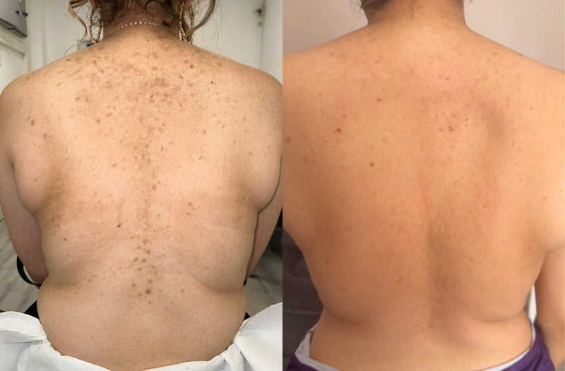 Treatment Result