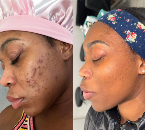 Skin Transformation Result