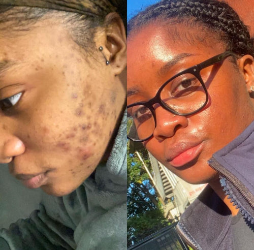 Skin Transformation Result