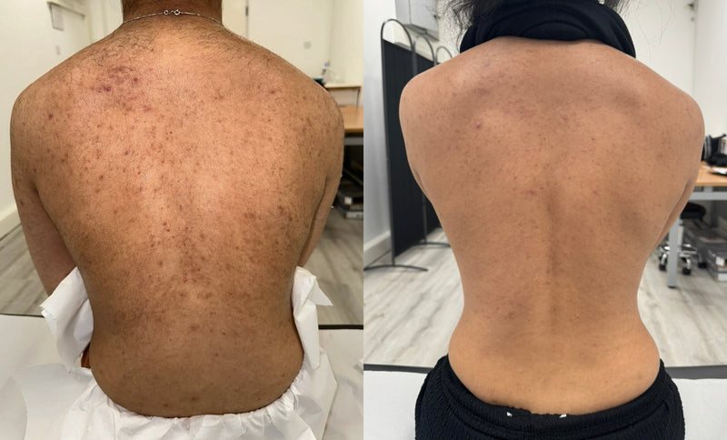 Treatment Result