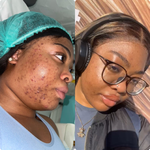 Skin Transformation Result