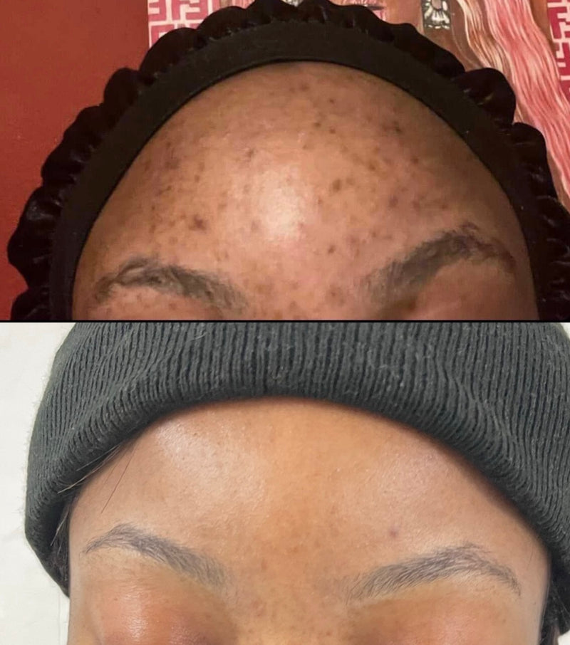 Treatment Result
