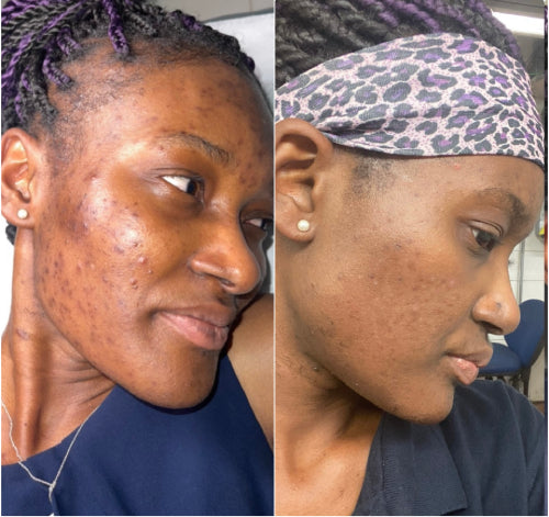 Skin Transformation Result