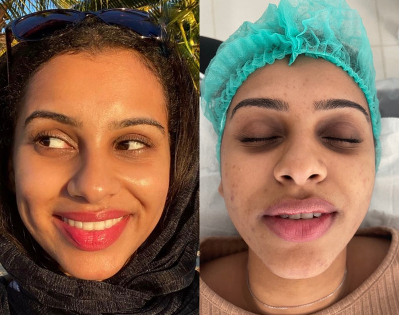 Treatment Result