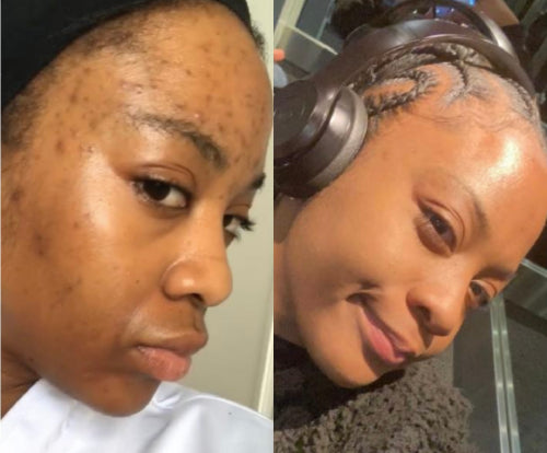 Skin Transformation Result