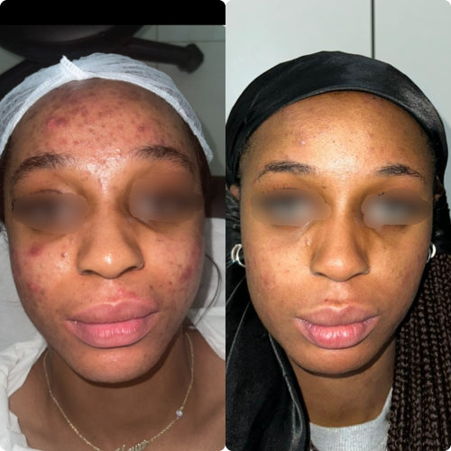 Skin Transformation Result