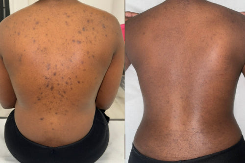 Skin Transformation Result