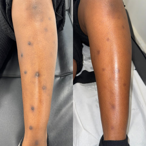 Skin Rotationplasty Skin Transformation Result