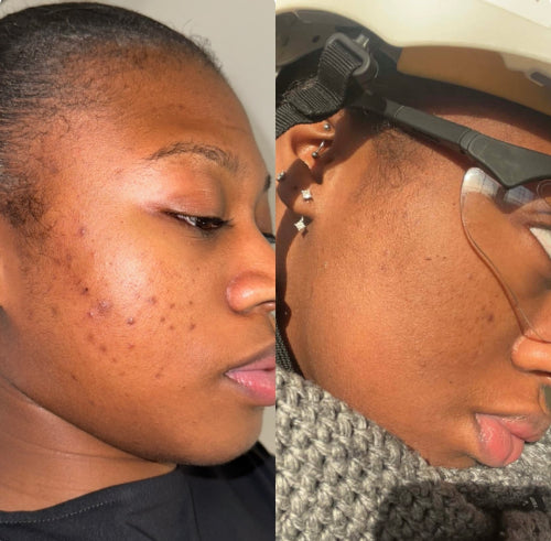 Skin Transformation Result