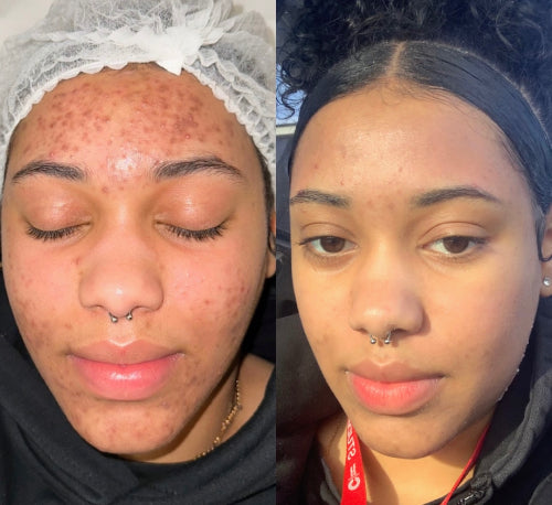 Skin Transformation Result