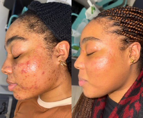 Skin Transformation Result
