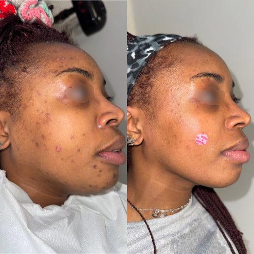 Skin Transformation Result